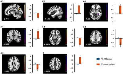 Antidepressant-induced mania in panic disorder: a single-case study of clinical and functional connectivity characteristics